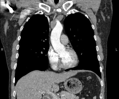 File:Bilateral pulmonary AVM (Radiopaedia 83134-97505 C 31).jpg