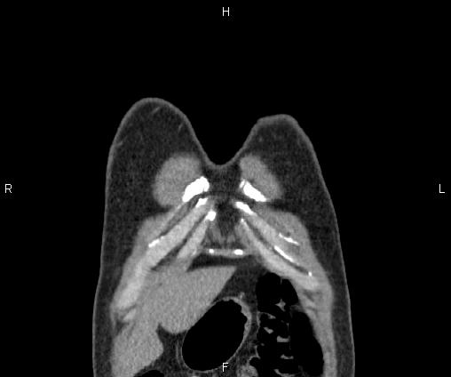 Bilateral pulmonary AVM (Radiopaedia 83134-97505 C 6).jpg