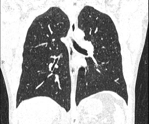 Bilateral pulmonary AVM (Radiopaedia 83134-97505 Coronal lung window 49).jpg