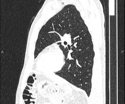 Bilateral pulmonary AVM (Radiopaedia 83134-97505 Sagittal lung window 75).jpg
