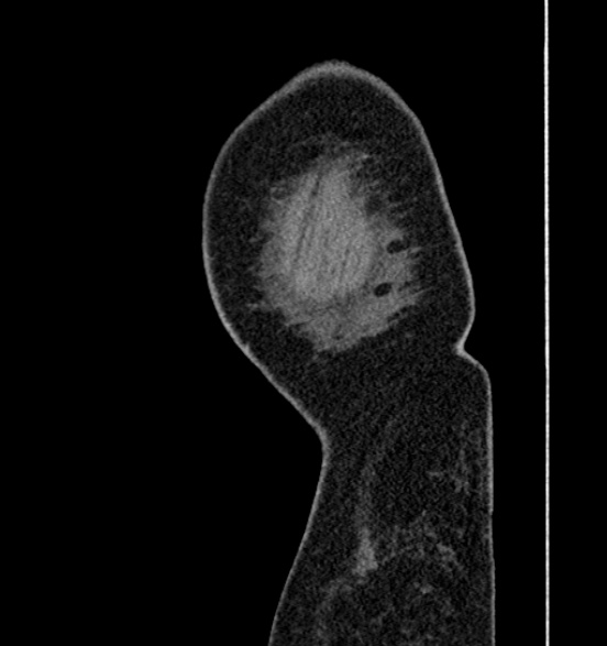 Bilateral rectus sheath hematomas (Radiopaedia 50778-56252 B 79).jpg
