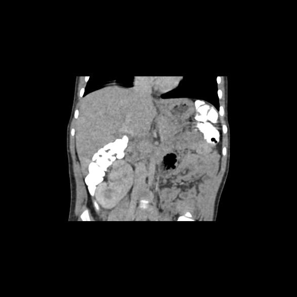 File:Bilateral renal malrotation (Radiopaedia 30901-31606 B 33).jpg