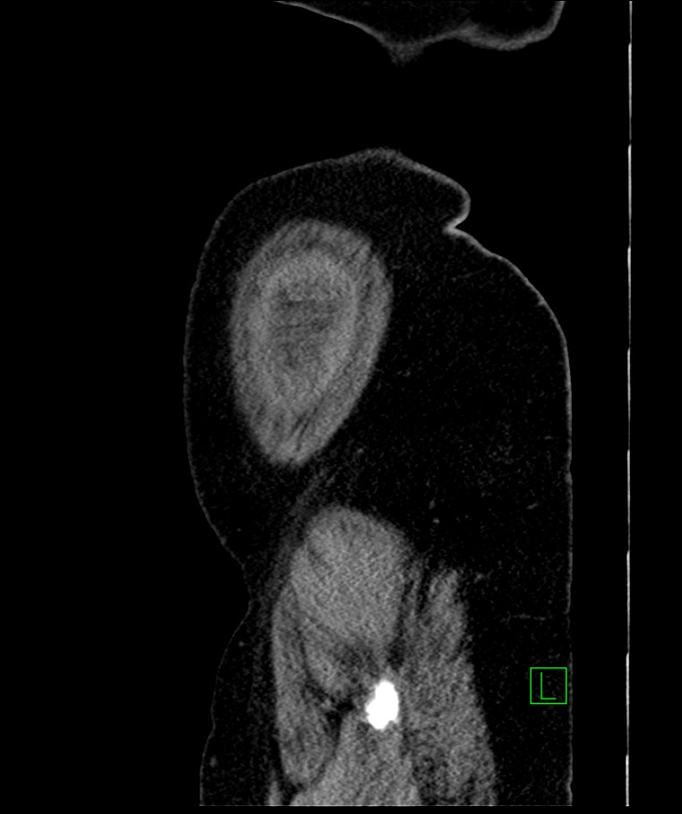 Bilateral sporadic synchronous clear cell renal cell carcinoma (Radiopaedia 85035-100575 E 11).jpg