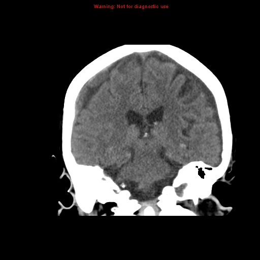 File:Bilateral subdural hemorrhage (Radiopaedia 8819-9620 Coronal non-contrast 10).jpg