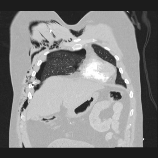 Bilateral traumatic renovascular injury (Radiopaedia 32051-32995 Coronal lung window 19).jpg