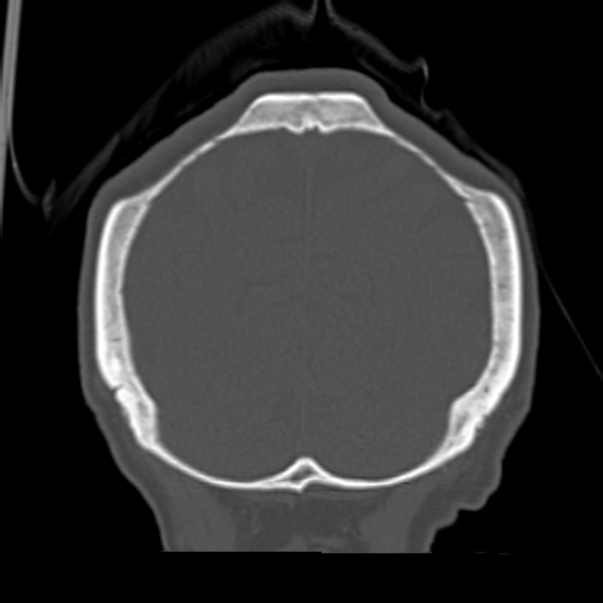 Biparietal osteodystrophy (Radiopaedia 46109-50463 Coronal bone window 89).jpg