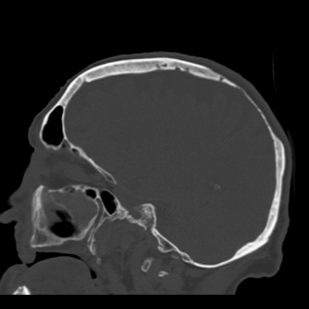 Biparietal osteodystrophy (Radiopaedia 46109-50463 Sagittal bone window 69).jpg