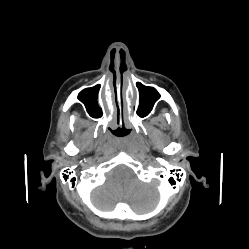 File:Bisphosphonate-related osteonecrosis of the jaw (Radiopaedia 71324-81642 non-contrast 137).jpg