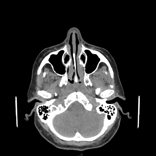 Bisphosphonate-related osteonecrosis of the jaw (Radiopaedia 71324-81642 non-contrast 145).jpg