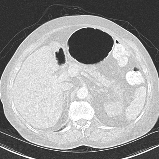 Bladder and bowel cancers (Radiopaedia 37688-39592 Axial lung window 53).png