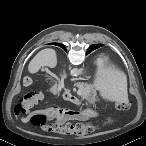 File:Bladder papillary urothelial carcinoma (Radiopaedia 48119-52951 Axial C+ delayed 11).png