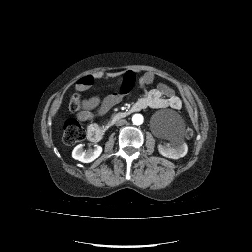 Bladder tumor detected on trauma CT (Radiopaedia 51809-57609 A 113).jpg