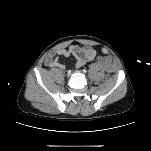 Blunt abdominal trauma with solid organ and musculoskelatal injury with active extravasation (Radiopaedia 68364-77895 A 113).jpg