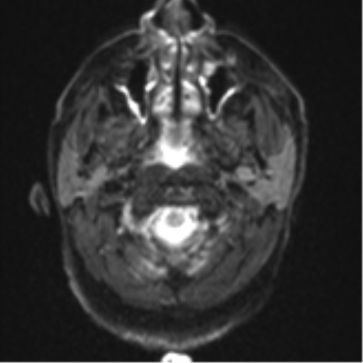 File:Blunt cerebrovascular injury (Radiopaedia 53682-59745 Axial DWI 2).png