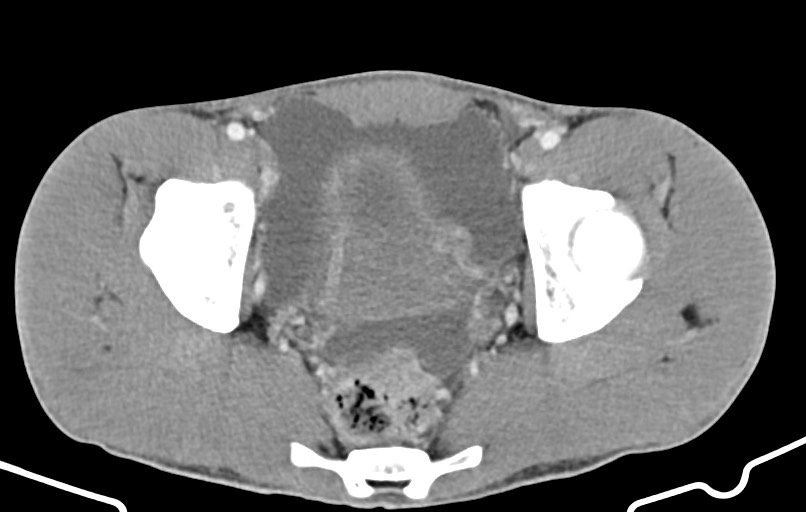 Blunt injury to the small bowel (Radiopaedia 74953-85987 A 173).jpg