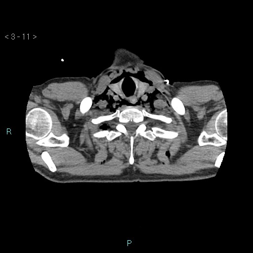 Boerhaave syndrome (Radiopaedia 27683-27897 oral contrast 11).jpg