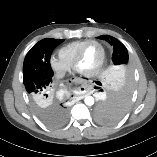 File:Boerhaave syndrome (Radiopaedia 39382-41661 A 37).png
