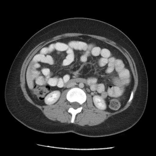 File:Borderline mucinous tumor (ovary) (Radiopaedia 78228-90808 A 89).jpg