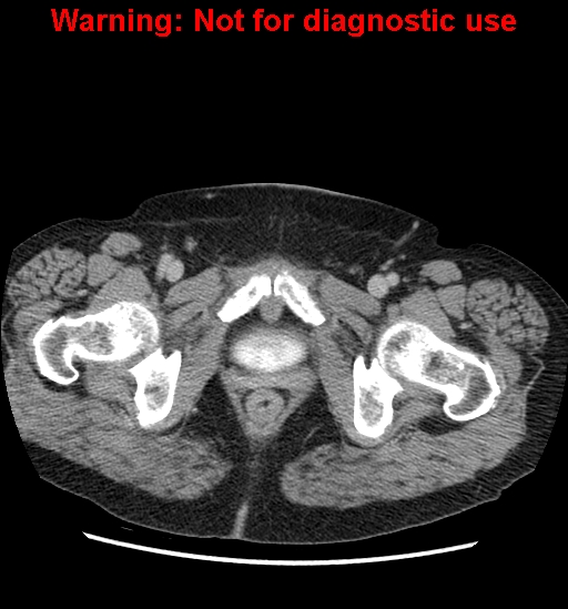 File:Bosniak renal cyst - type II (Radiopaedia 23404-23468 F 68).jpg