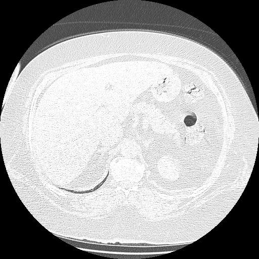 Bovine aortic arch - right internal mammary vein drains into the superior vena cava (Radiopaedia 63296-71875 Axial lung window 182).jpg