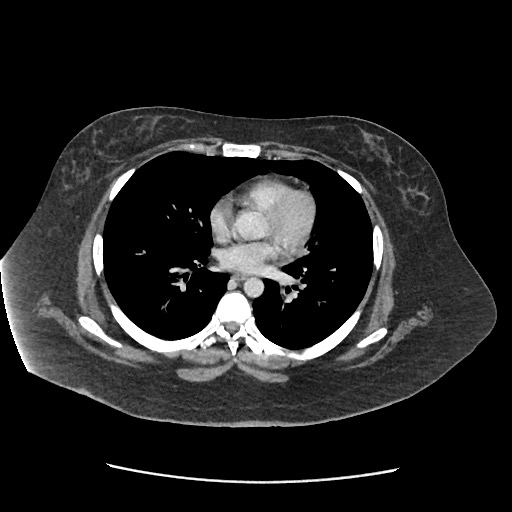 Bowel and splenic infarcts in acute lymphocytic leukemia (Radiopaedia 61055-68915 A 5).jpg