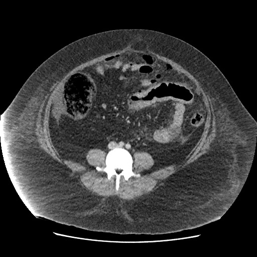 Bowel and splenic infarcts in acute lymphocytic leukemia (Radiopaedia 61055-68915 A 84).jpg
