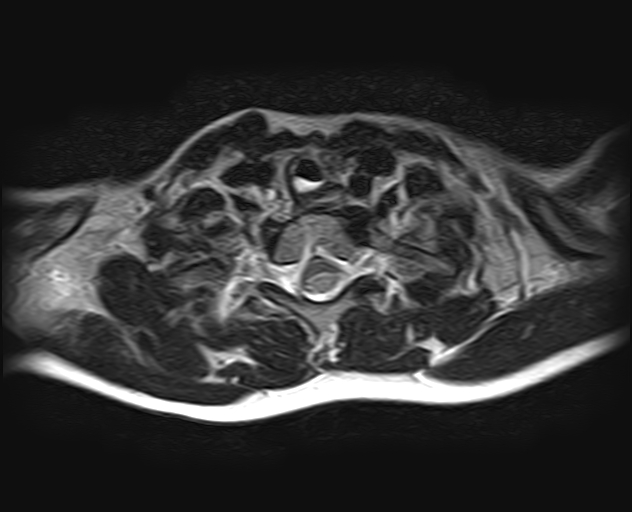 File:Brachial plexus birth palsy (Radiopaedia 68118-77604 Axial T2 17).jpg
