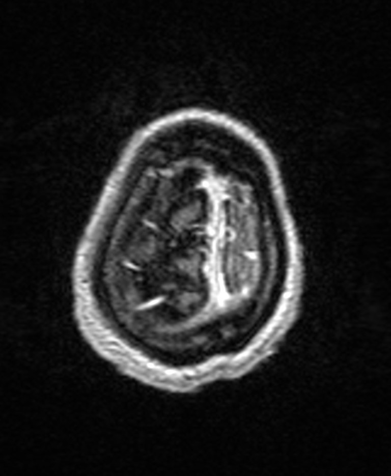 Brain abscess with dual rim sign (Radiopaedia 87566-103938 Axial T1 C+ 147).jpg