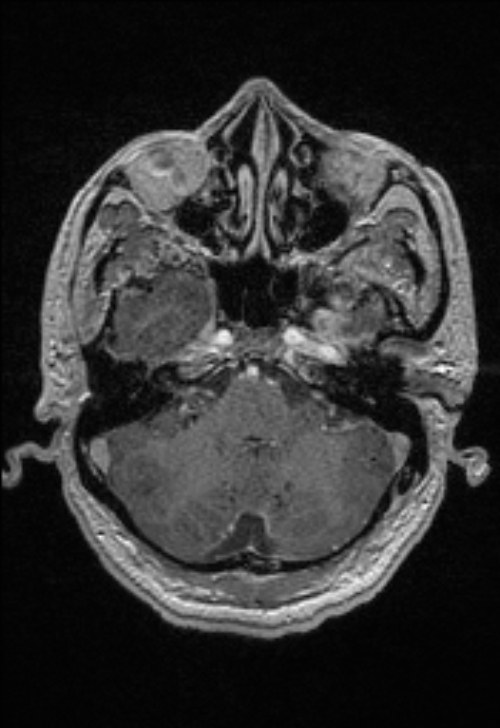 Brain abscess with ventriculitis (Radiopaedia 85703-101495 Axial T1 C+ 45).jpg