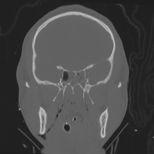 File:Brain contusions, internal carotid artery dissection and base of skull fracture (Radiopaedia 34089-35339 Coronal bone window 29).png