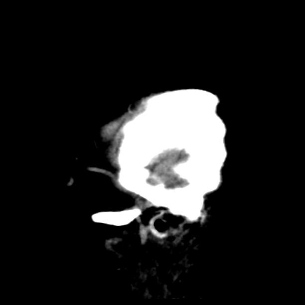 Brain cortical laminar necrosis (Radiopaedia 25822-25971 non-contrast 47).jpg