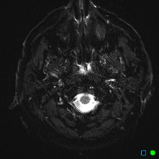 File:Brain death on MRI and CT angiography (Radiopaedia 42560-45689 Axial ADC 3).jpg