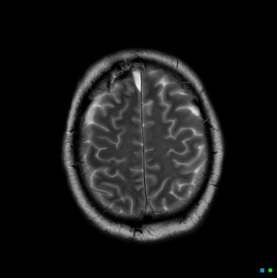 File:Brain death on MRI and CT angiography (Radiopaedia 42560-45689 Axial T2 26).jpg