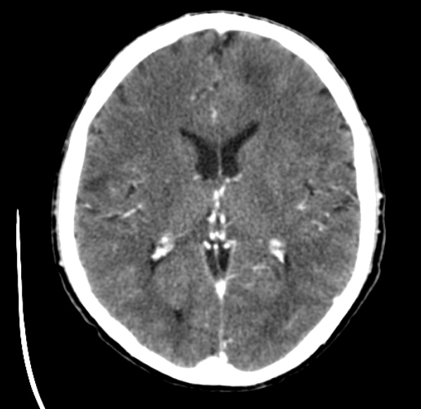 File:Brain metastases from lung cancer (Radiopaedia 24480-24781 Axial C+ delayed 33).jpg