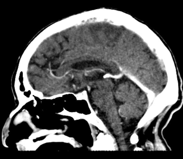 Brain metastases from lung cancer (Radiopaedia 27849-28092 Sagittal C+ delayed 31).jpg
