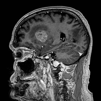 Brain metastases from lung cancer (Radiopaedia 83839-99028 Sagittal T1 C+ 21).jpg