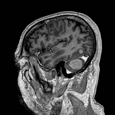 Brain metastases from lung cancer (Radiopaedia 83839-99028 Sagittal T1 C+ 52).jpg