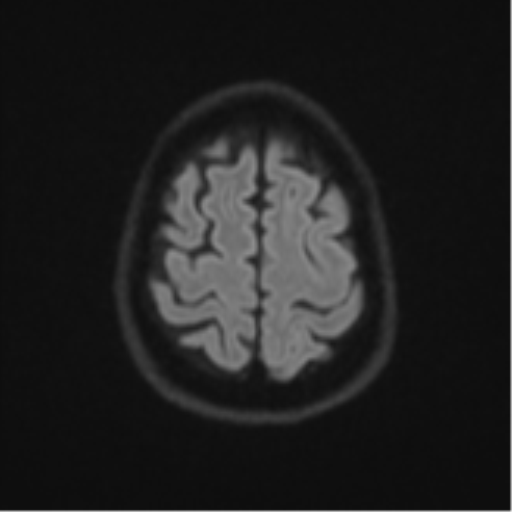 Brain metastasis (large cystic mass) (Radiopaedia 47497-52107 Axial DWI 51).png