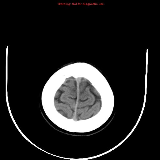File:Brainstem glioma (Radiopaedia 9444-10123 non-contrast 24).jpg