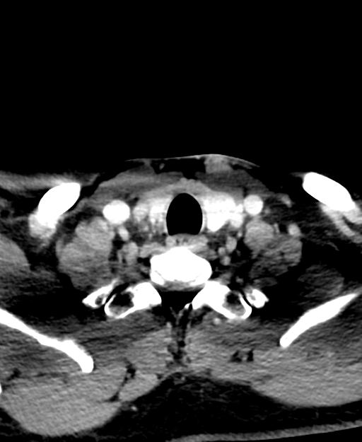 Branchial cleft cyst (Radiopaedia 31167-31875 Axial C+ delayed 57).jpg