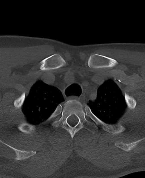 Branchial cleft cyst (Radiopaedia 31167-31875 Axial bone window 73).jpg