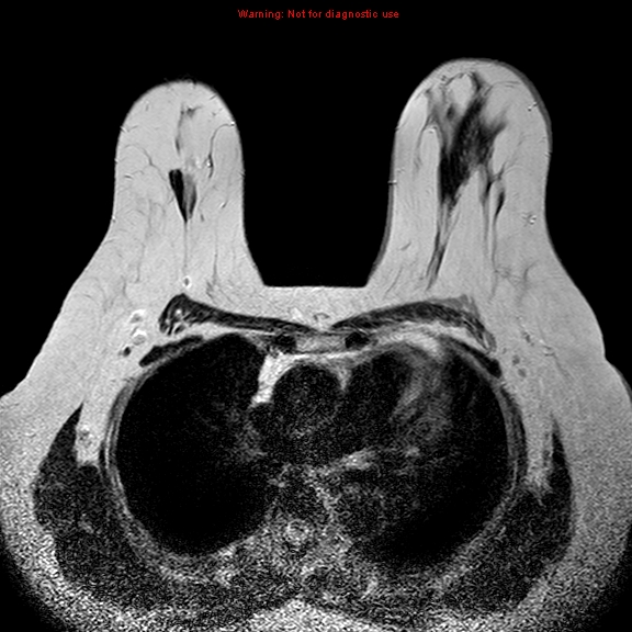 File:Breast carcinoma (multicentric multifocal in mammary Paget disease) (Radiopaedia 50966-56512 Axial T2 14).jpg