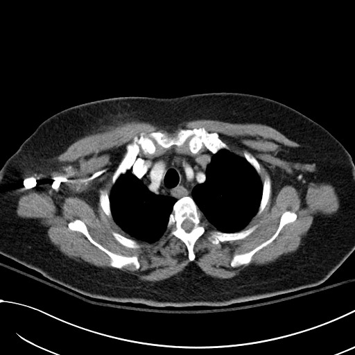File:Breast carcinoma with pathological hip fracture (Radiopaedia 60314-67974 A 11).jpg
