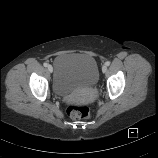 File:Breast metastases from renal cell cancer (Radiopaedia 79220-92225 C 106).jpg