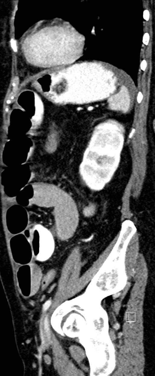 Broad ligament hernia (Radiopaedia 84802-100276 C 18).jpg