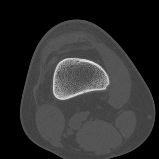 Brodie abscess of the tibia (Radiopaedia 58984-66250 Axial bone window 12).jpg