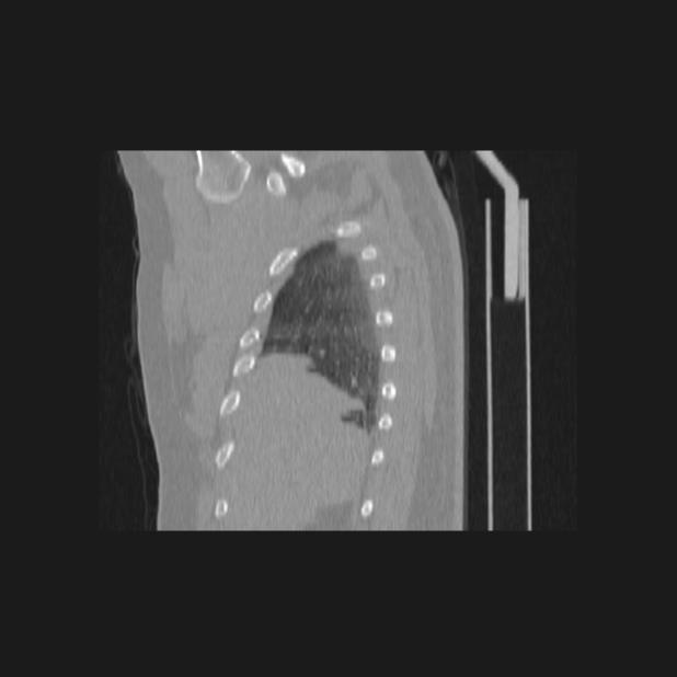 Bronchial atresia (Radiopaedia 60685-68439 Sagittal lung window 9).jpg