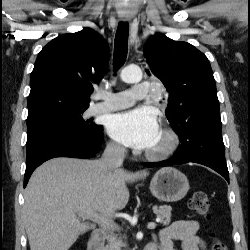 Bronchial carcinoid tumor (Radiopaedia 67377-76764 C 35).jpg