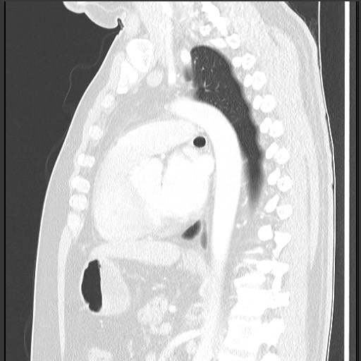 Bronchial carcinoid tumor (Radiopaedia 67377-76764 Sagittal lung window 40).jpg