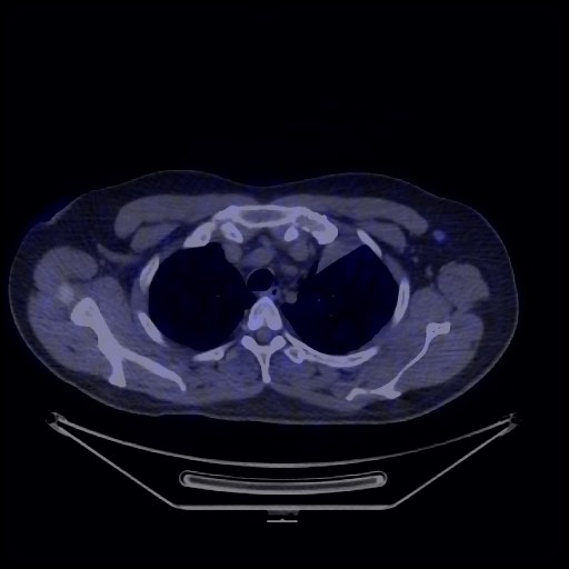 Bronchial carcinoid tumor (Radiopaedia 67377-76765 68Ga-DOTATATE PET-CT 21).jpg